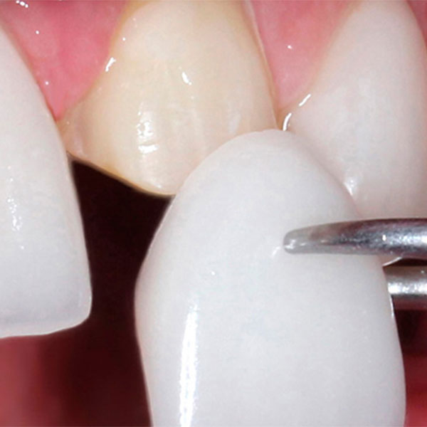 veneers-frankfurt-02