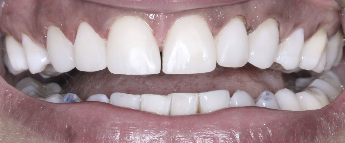 Bonding Direkte Asthetische Zahnkorrekturen Asthetische